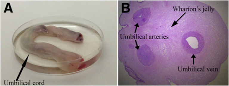 POTENSI DAN PERBANDINGAN UMBILICAL CORD DENGAN UMBILICAL CORD BLOOD